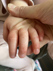 Is this chicken pox or HFM please?