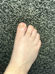 Fungal nails