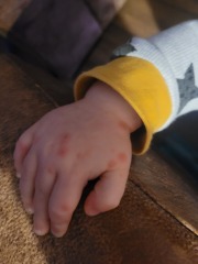 Chicken pox or hand foot and mouth?