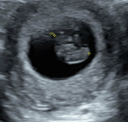 When to book private ultrasound