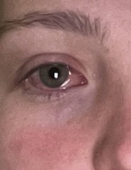 My poor eye