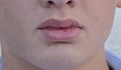 Lip filler everywhere