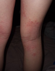 What's this rash?
