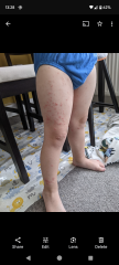 Chicken pox or hand foot and mouth?