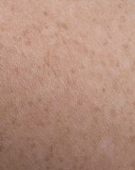 Is this mark Seborrheic Keratosis?