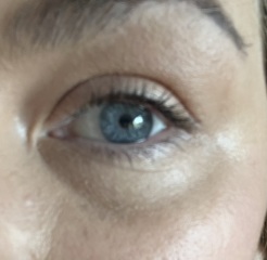 Any cosmetic nurses here? Pic attached -  Do I need Botox or tear trough filler?