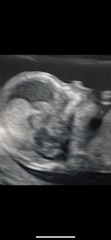 Is there a nasal bone present?