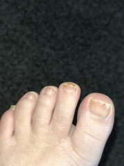 Fungal nails