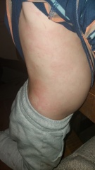 What's this rash?