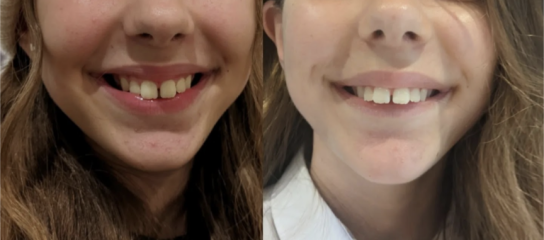Twin block braces at 14