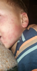 What's this rash?