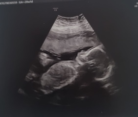 Nub theory - i have my 20 week scan tomorrow