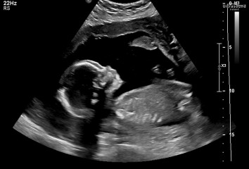 20 week scan boy or girl ?