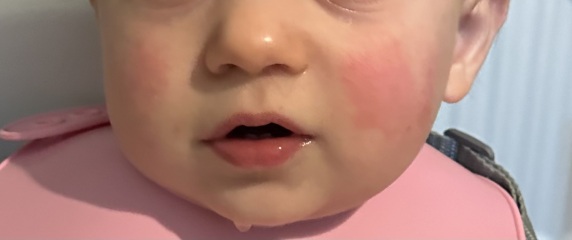 Teething / viral rash or scarlet fever?!