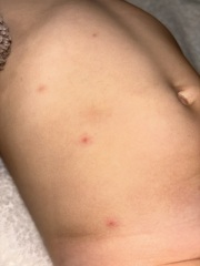 HELP! Toddler has had "chickenpox" since March