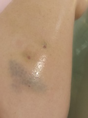 Fragmin injections bruising