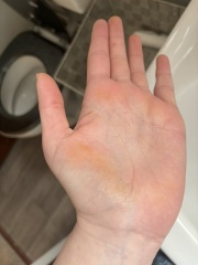 Hand Turning Yellow