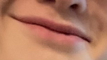 Lip filler everywhere
