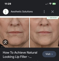 Lip filler everywhere