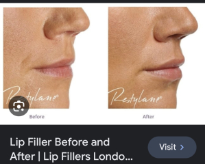 Lip filler everywhere