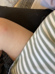 Spots on 17m old