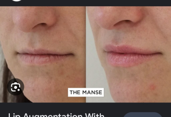 Lip filler everywhere