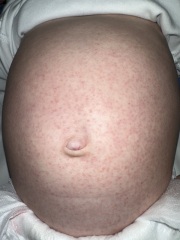 Teething / viral rash or scarlet fever?!