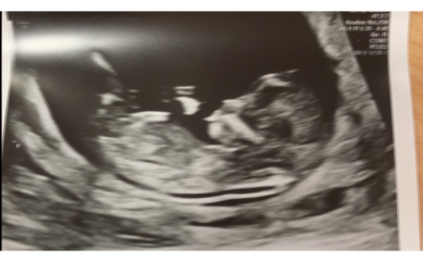 Nub or umbilical cord ?
