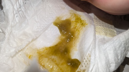 Diarrhoea for 14 days! (*TRIGGER: IMAGE ATTACHED)