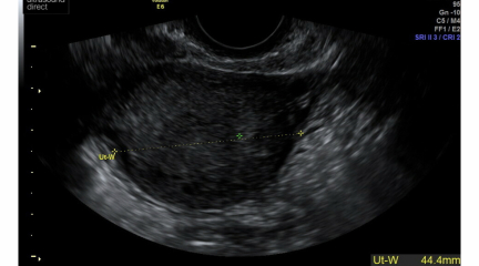 Advice on attached ultrasound