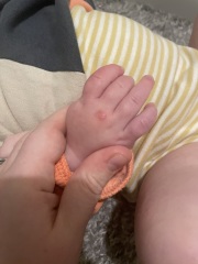 Not sure where to post does this look like chickenpox