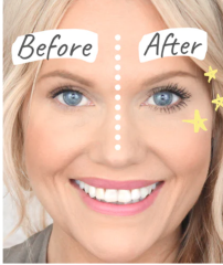 What is with lip fillers?!? They look so fake and awful