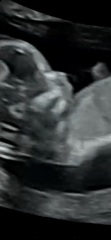 Is there a nasal bone present?