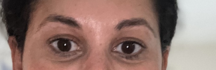 Does ANYTHING help with dark circles and hollow under eyes? 😩