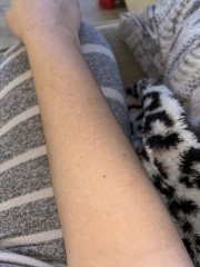 Sudden bruising and odd rash?