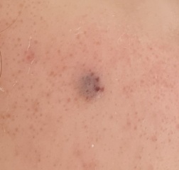 Weird spot/pimple on cheek