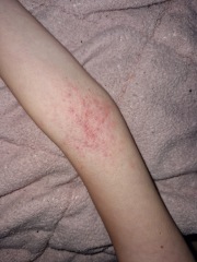 What's this rash?