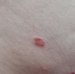 Help.. What are these bites?