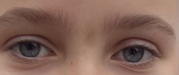 Birth mark with hair growing