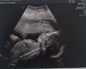 Nub theory - i have my 20 week scan tomorrow