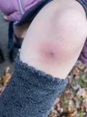 6 year old- lump on knee