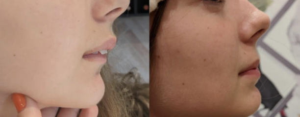 Twin block braces at 14