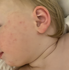 Is this chicken pox or HFM please?
