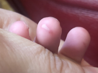 Hand, Foot & Mouth.