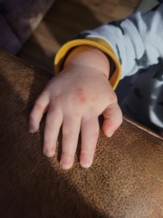 Chicken pox or hand foot and mouth?