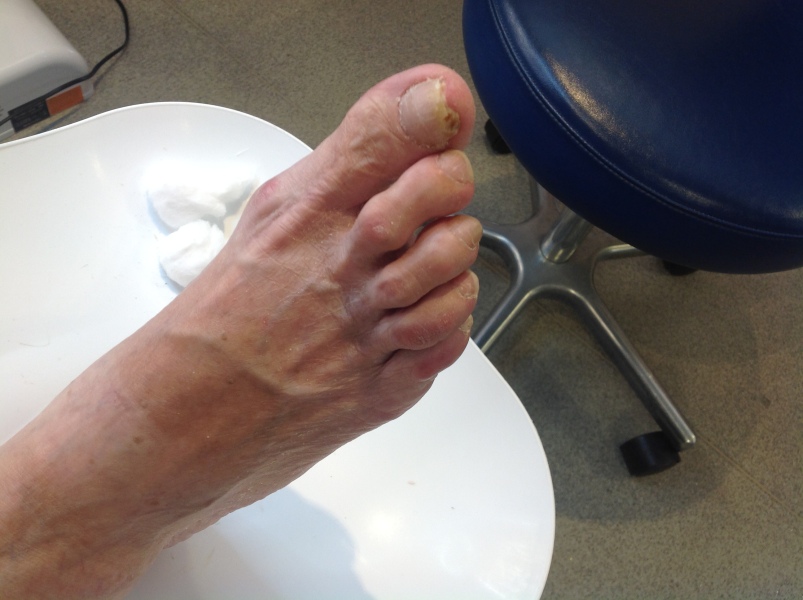 Best fake toenail