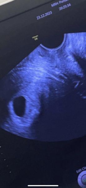 Miscarriage? Very confused