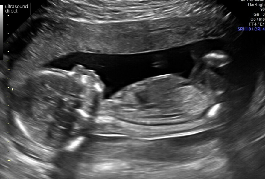 Found out at 16 weeks!! Happy but worried first timer looking for any advice. Missed any tests, meds etc so far.