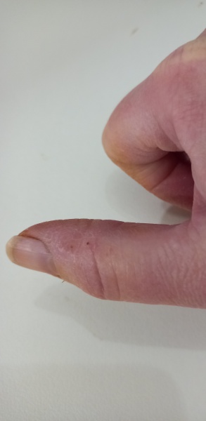 Woke up up with bite mark - bat?