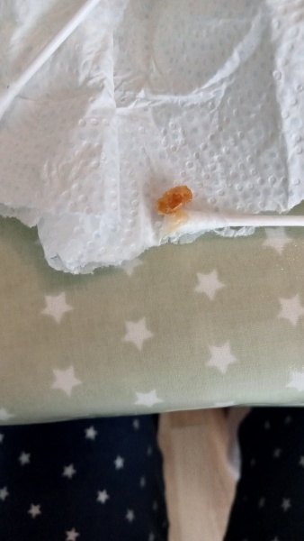 Extracted from my son's ear [pic]